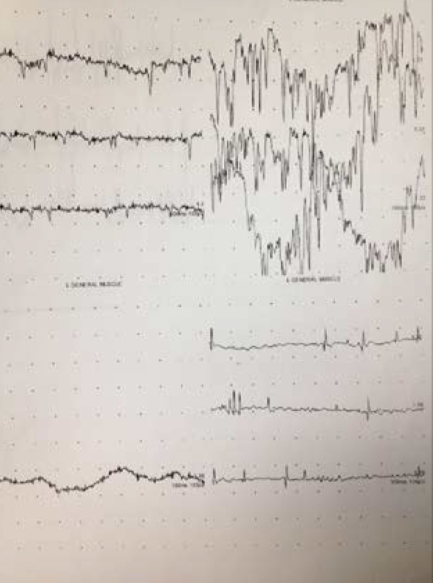 Sciatic Nerve Lesion - Sechrist Hyperbaric Animal Chamber